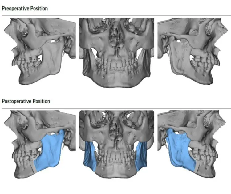 lower jaw surgery